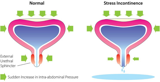 Schema: Stresová inkontinence